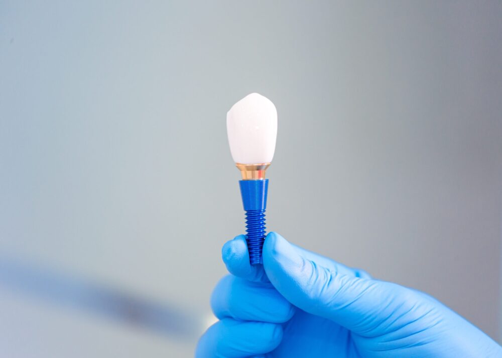 dental implants near me
